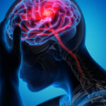 Illustration showing common stroke symptoms using the FAST method including facial drooping, arm weakness, and speech difficulty